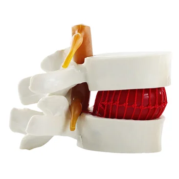 Modelis Mugurkaula Jostas Disku Trūces Cilvēku Modeļi Anatomijas Skriemeļu Anatomiju Mugurkaula Mācību Starpskriemeļu Chiropractic